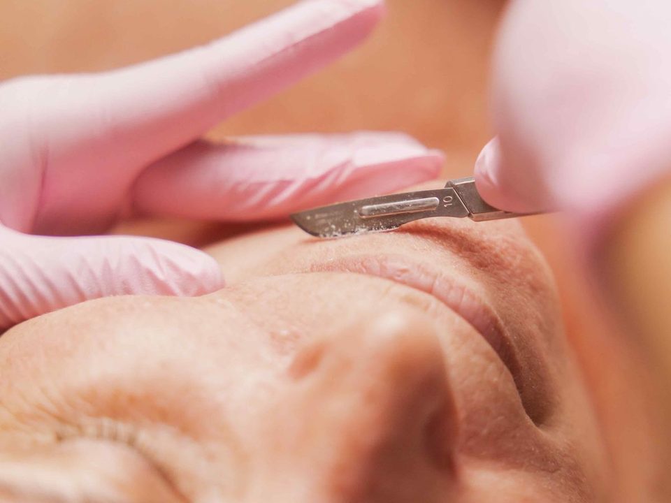 Dermaplaning en Trisquel
